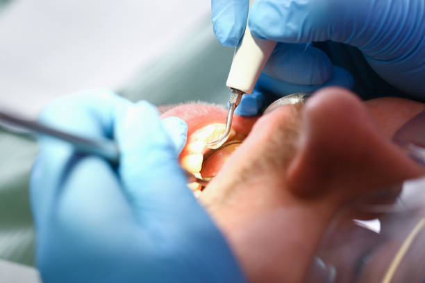 Best Emergency Dentist for Lost Fillings or Crowns in Sangaree, SC